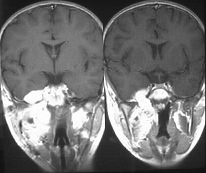 Rhabdomyosarcoma